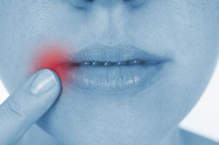 How to Treat and Prevent Cold Sores
